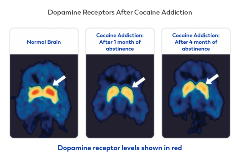 addictin and brain recovery
