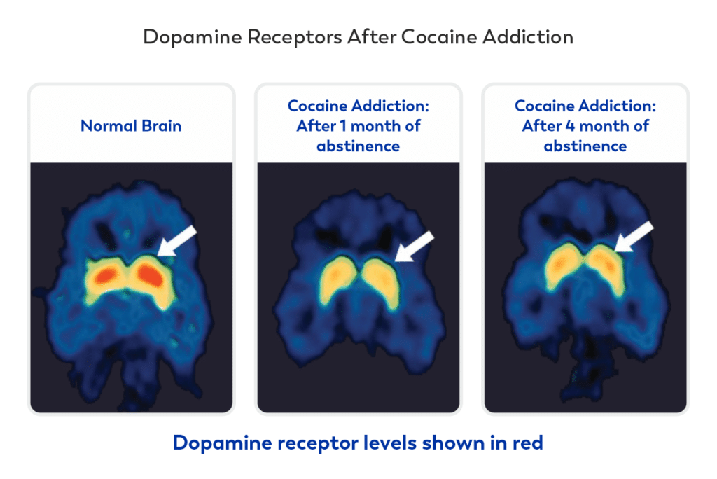 addictin and brain recovery